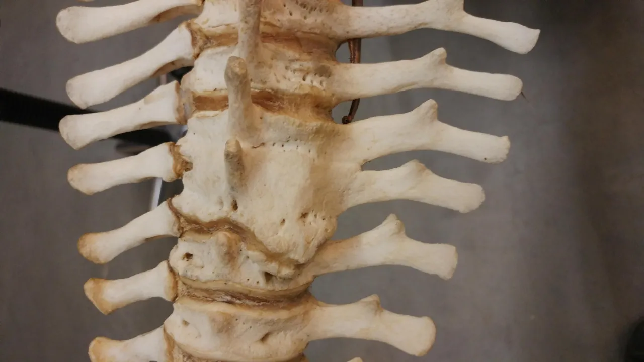 Totally fused vertebrae.