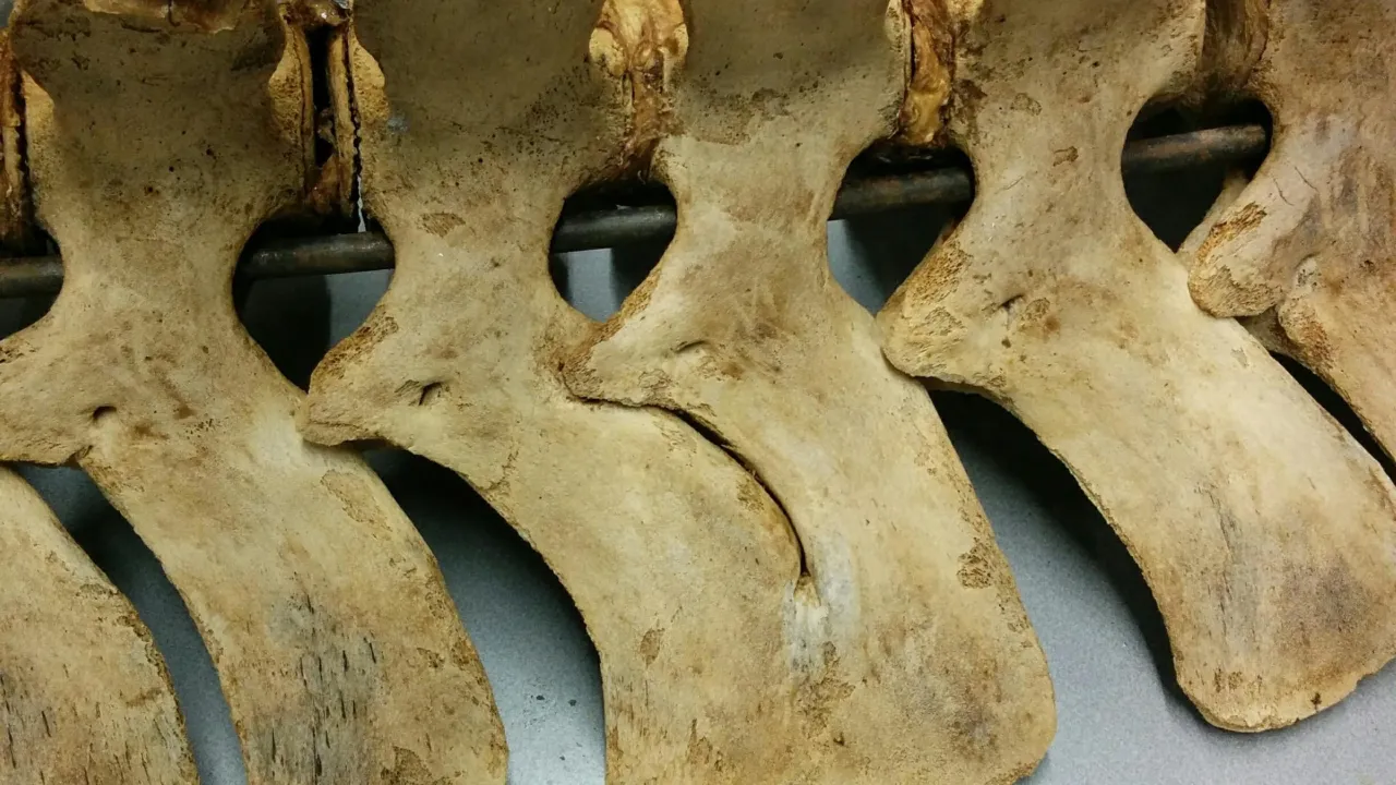 Fused vertebrae